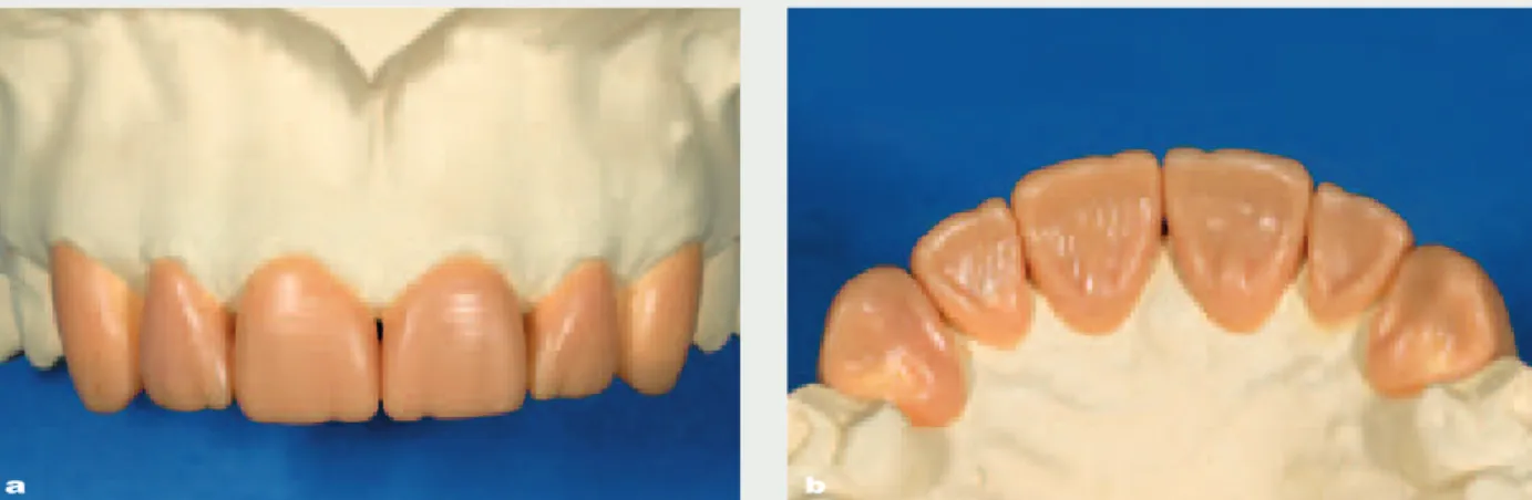 Fig 2a and b Diagnostic waxup of the superior front teeth. The vertical dimensions are lengthened by 2 mm, thus creating space for a functional anatomical form.