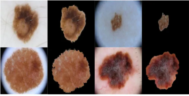 Fig 2. The original color image and its extracted lesion.