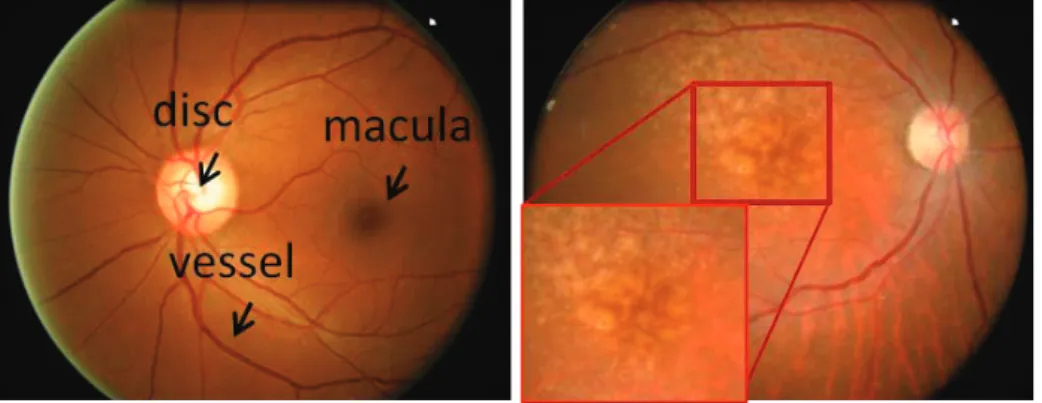 Fig. 1. Examples of fundus images with and without drusen.