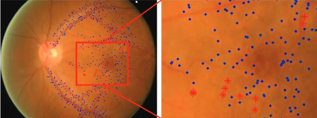 Fig. 2. An example of sparse bag. True and false drusen points are marked with red stars and blue dots, respectively