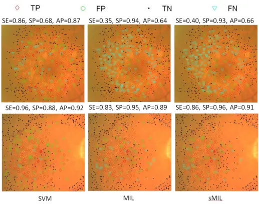 Fig. 3. Examples of drusen classification results. Top row shows a failure case in which MIL and sMIL obtain lower sensitivity