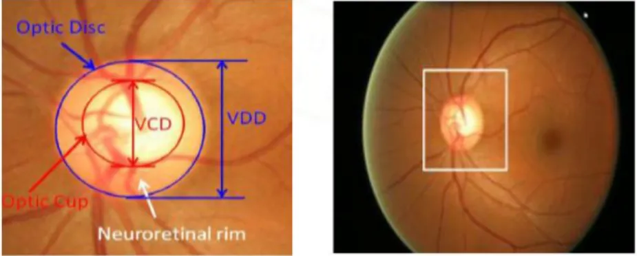 Figure 1. Image of Optic cup and disc 
