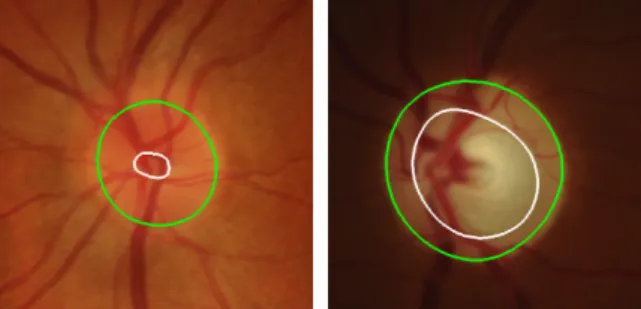 Figure 1: Examples of retinal fundus images of a healthy (left) and glaucomatous (right) subject, cropped to highlight the optic nerve head