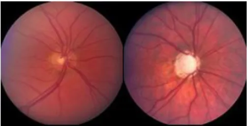 Figure 10. (a) Normal optic disc  (b) Glaucomatous optic disc 