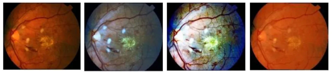 Figure 5. Effect of color normalization on abnormal retina 