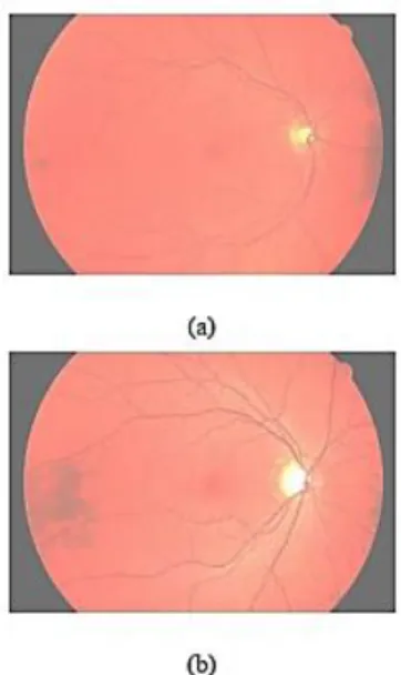 Fig. 1. Example of (a) glaucoma and (b) healthy  images of High Resolution Fundus (HRF) image 