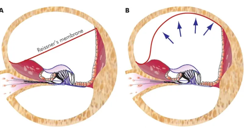 Fig. 5.1: (A) Normal cochlear duct. (B) Cochlear duct is distended with endolymph pushing 