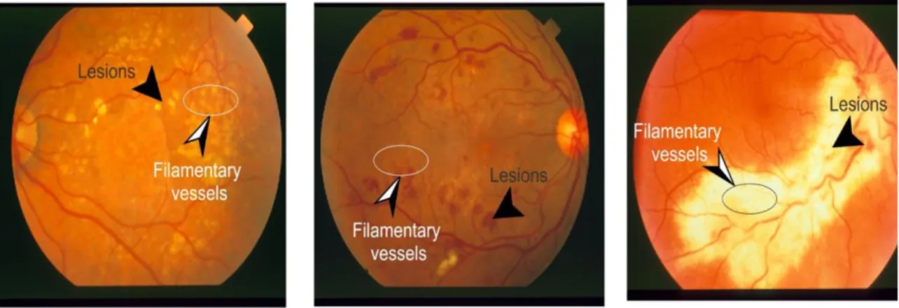 Figure 2.13 Effect of retinal lesions on filamentary vessel structures appearance. 