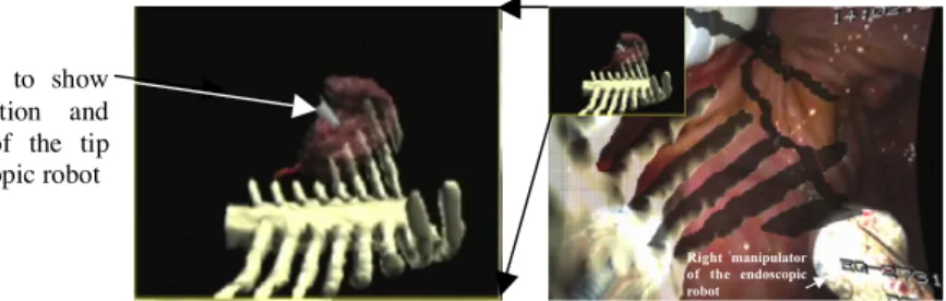 Fig.  9.  A  superimposed  image  on  the  GWS  display.  (Organ  models  (spine,  ribs  and  hepatic artery)  are  superimposed  onto  the  endoscope’s  image)