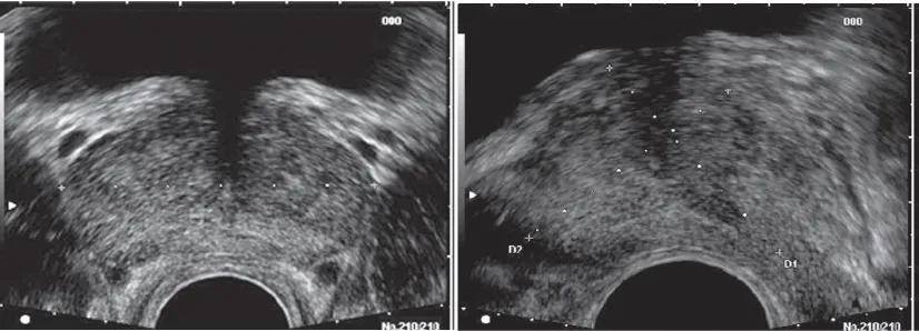 Figure 2Trans rectal ultrasound image of the prostate.A, 