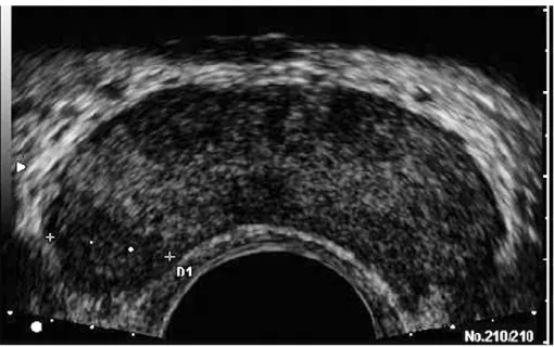 Figure 3: Hypo-echoic lesion noted on the right lateral aspect of prostate 