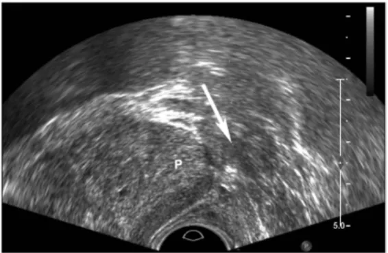 Figure 5: Ultrasound image of the anaesthetic injection site during peri- prostatic nerve bundle block