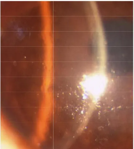 Figure 2 a -1 week postoperative photograph showing stromal haze 1 week postoperative photograph showing stromal haze  1 week postoperative photograph showing stromal haze 