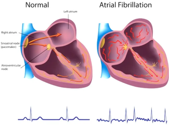 Fig. 1 –  Electrical activity of a normal heart (left) and a heart with atrial fibrillation (right) [3] 