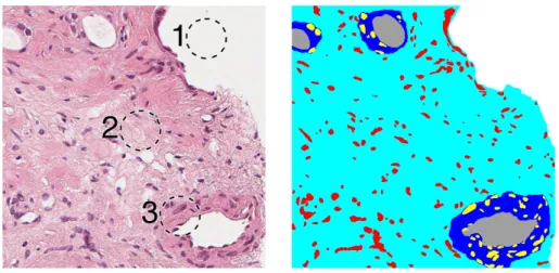 Figure 1.2: Example of segmentation of a prostate biopsy sample. To the left is the original image and to the right is the segmentation map