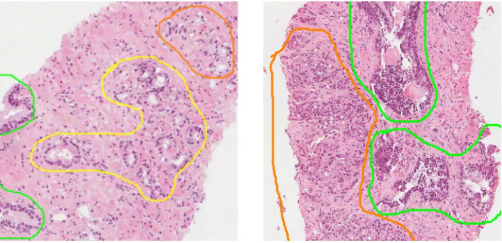 Figure 2.1: Example of annotation in the available dataset. Areas encircled in green, yellow and orange correspond to benign tissue, Gleason pattern 3 and Gleason pattern 4, respectively.