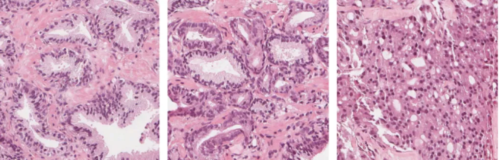 Figure 1.1: H&amp;E-stained images from prostate biopsies. From left to right, examples of benign, Gleason 3 and Gleason 4 patterns respectively.