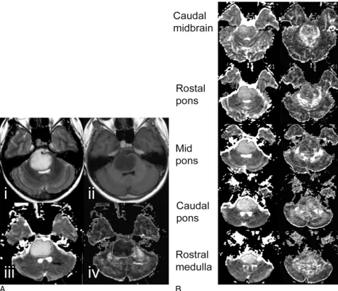 Fig 1. A, Anatomic T2-weighted (i) and T1-weighted MR images (ii) of a DIBSG at initial presentation