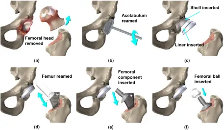 Figure 2.4: Typical procedures of total hip replacement 