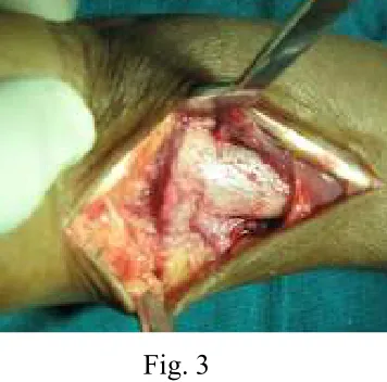 4.Fig. 3  Sleeve fixed in the threads of locking compression plate after 