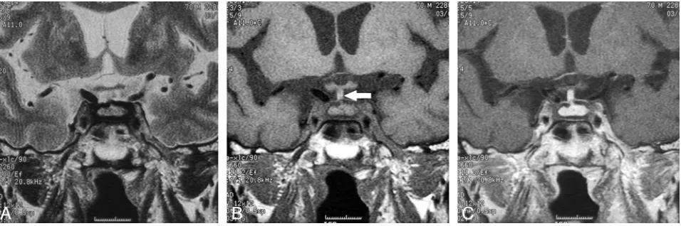 Fig 1. MR images of LYH (case 1) in a 38-year-old woman with partial hypopituitarism and diabetes insipidus