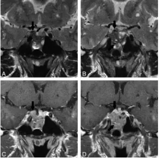 Fig 4. MR images of pituitary adenoma (case 5) in a 54-year-old woman. Acromegaly and partial hyperpituitarism were observed