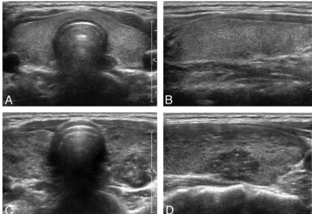 Fig 1. Category of no evidence of DTD in a 28-year-old woman. A and B, Transverse and longitudinal sonographic images of the thyroid show isoechogenicity, fine echotexture, an APdiameter from 1 to 2 cm, normal vascularity, a smooth margin, and the absence 