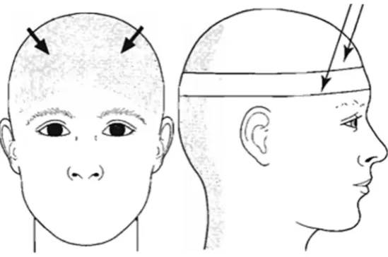 Figure 3-TENSION HEADACHE
