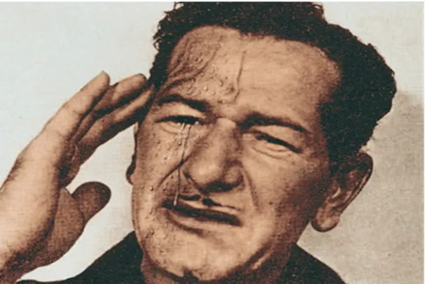 Figure 4-CLUSTER HEADACHE