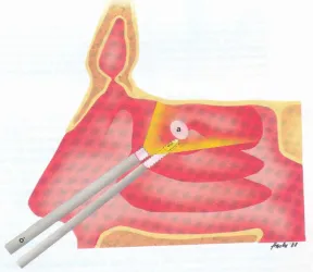 Figure-14: Position of instrument in case of 0º endoscope