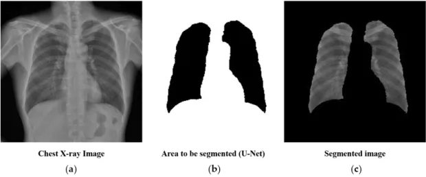 Figure 1. Lung segmentation using U-Net before training the convolutional neural network: (a) the original chest X-ray image, (b) a mask of lung structures segmented through U-Net, and (c) the final segmented image of the lungs.