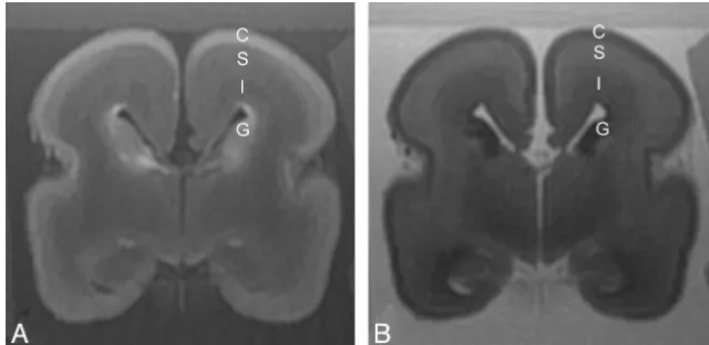 Fig 1. A 22-week fetus with normal cerebral lamination.intensity relative to the subplate layer, and the cortex is of high T1 signal intensity