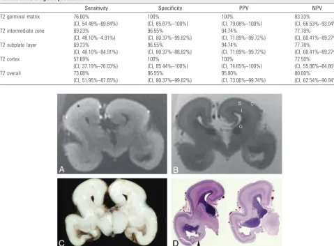 Table 3: Sensitivity, specificity, and positive and negative predictive values of the germinal matrix, intermediate zone, subplate layer, andcortex on T2-weighted postmortem MRI