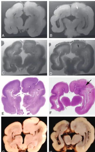 Fig 3. A 29-week fetus with neuronal migration disorder.caudate nuclei as well as focal infarcts as indicated by asterisks