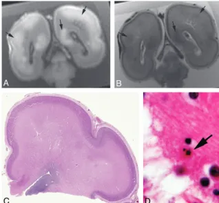 Fig 5. Awithin the subplate layer and intermediate zone. The sulcation and gyration pattern is normal.age-appropriate., 25-week fetus with hypoxic-ischemic injury