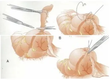 Fig : Steps in Open appendectomy 
  