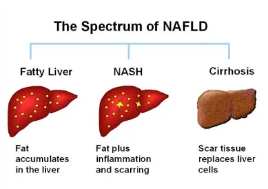 Figure 1show spectrum of nonalcoholic liver disease. 