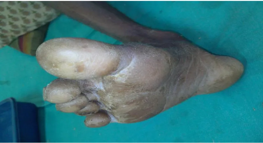 Fig.3 Neuropathic ulcer over metatarsal head