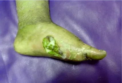 Fig.5  Neuro-Ischaemic ulcer with cellulitis over medial aspect of foot