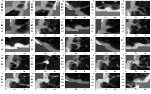 Figure 3.5 Quantity of Nodules Identified for a Patient Label Zero 