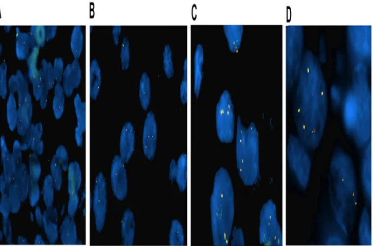Fig 1. Representative ALK fluorescent in situ hybridization (FISH) images in IBC patients