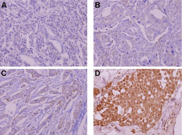Fig 2. Representative immunohistochemical staining of ALK. (A) negative staining, (B) 10% staining, (C) 50% staining, and (D) 80% staining of tumor cells.