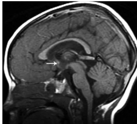 Fig 1. T1-weighted midsagittal image shows a hypogenetic CC in a patient with (p)LIS1.The rostrum is absent, the inferior part of the genu is small, and the splenium is thin