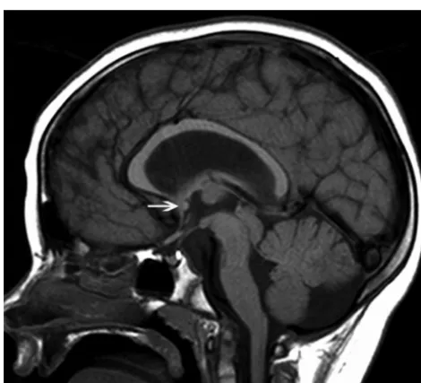 Fig 4. The image of the (p)LIS case shows no rostrum, a small inferior genu, a flat corpus,and a vertically angled splenium