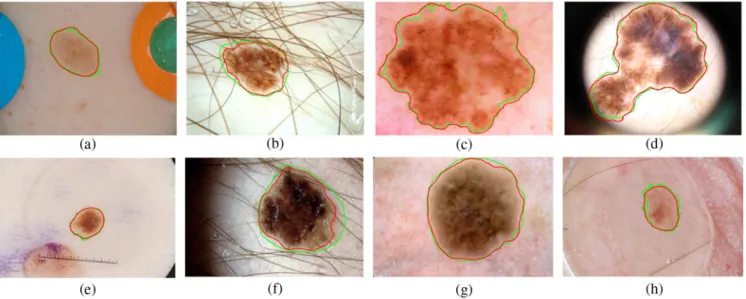 Table 4 Results of skin lesion segmentation methods using the ISBI 2017 challenge testing dataset