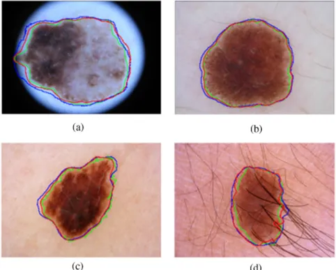 Figure 5 shows the results of our fully automatic segmenta- segmenta-tion method for the ISBI 2016 testing dataset [Figs