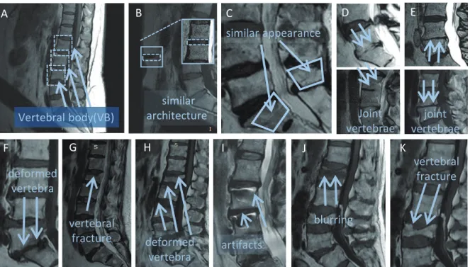 Figure 2.1. Challenges in the automatic vertebral body segmentation and detection. Our method is robust to all these challenges