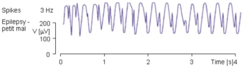 Figure 2.2: The spike and slow wave complexes in a patient with absence seizures, from [13]