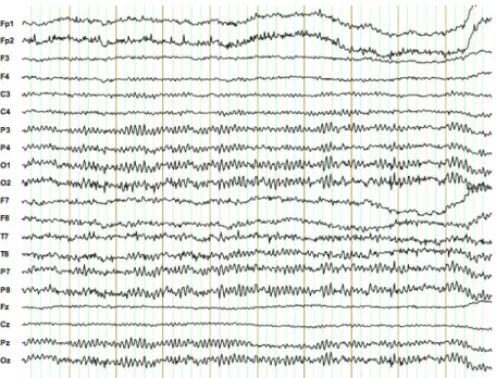 Figure 2.5: Unipolar EEG