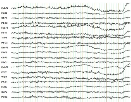 Figure 2.6: Bipolar EEG